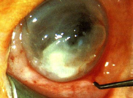 Keratitis yang disebabkan oleh Pseudomonas pada bayi baru lahir.  Faktor ramalan tidak dikenalpasti