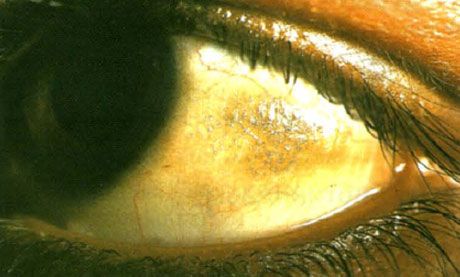 Xerophthalmus.  Plak Bito kelihatan tinggi, dengan pemendapan pelbagai skala, tapak konjunctiva terletak di zon yang tidak diliputi oleh kelopak mata.  Seperti dalam kes ini, kawasan patologi sering berpigmen.