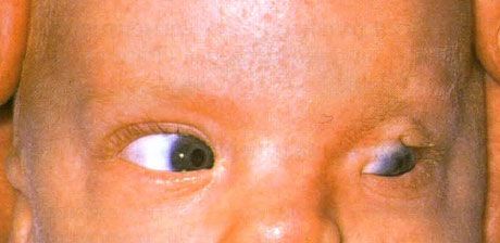 Sindrom Fraser.  Cryptophthalmos yang tidak lengkap dari mata kiri.