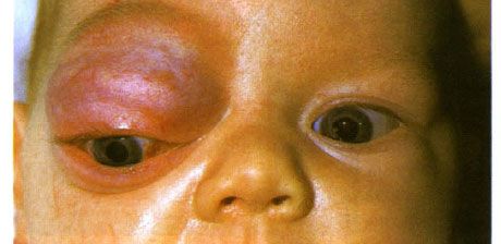 Hemangioma kapilari bahagian anterior orbit dan kelopak mata bahagian atas.  Neoplasma cenderung untuk maju