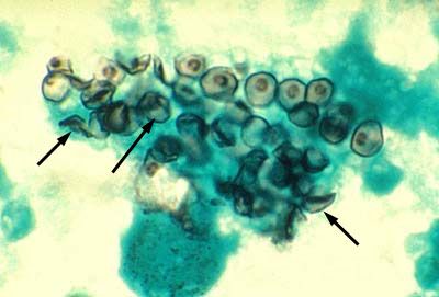 Agen penyebab pneumocystis (Pneumocystis jiroveci)