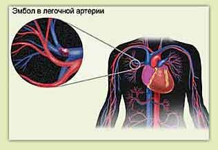 Embolisme pulmonari dan sakit dada di sebelah kiri