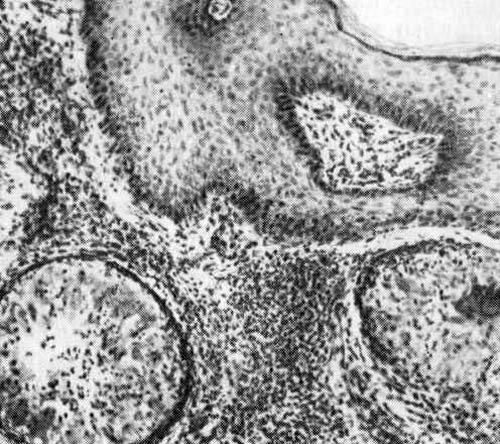 Pathogens chromoblastomycosis